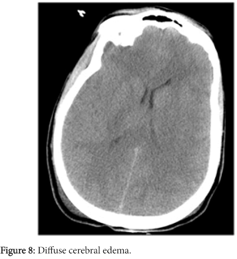 radiology-Diffuse-cerebral-edema