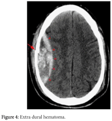 radiology-Extra-dural-hematoma