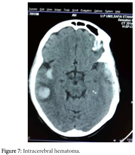 radiology-Intracerebral-hematoma