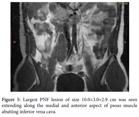 radiology-Largest-PNF