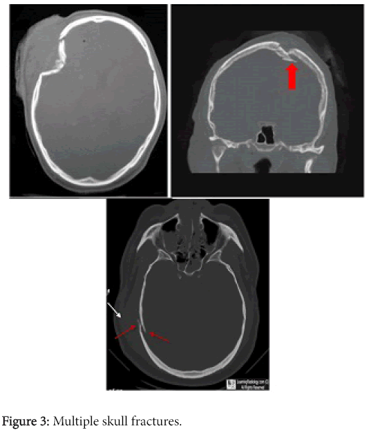 radiology-Multiple-skull-fractures