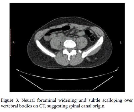 radiology-Neural-foraminal