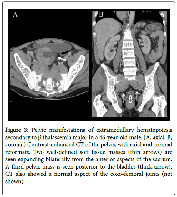 radiology-Pelvic-manifestations-extramedullary