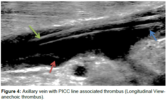 radiology-associated-thrombus