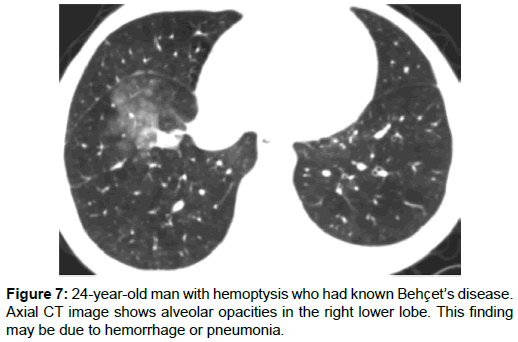 radiology-hemorrhage-pneumonia