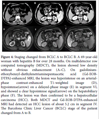 radiology-hepatocellular-carcinoma-gadolinium