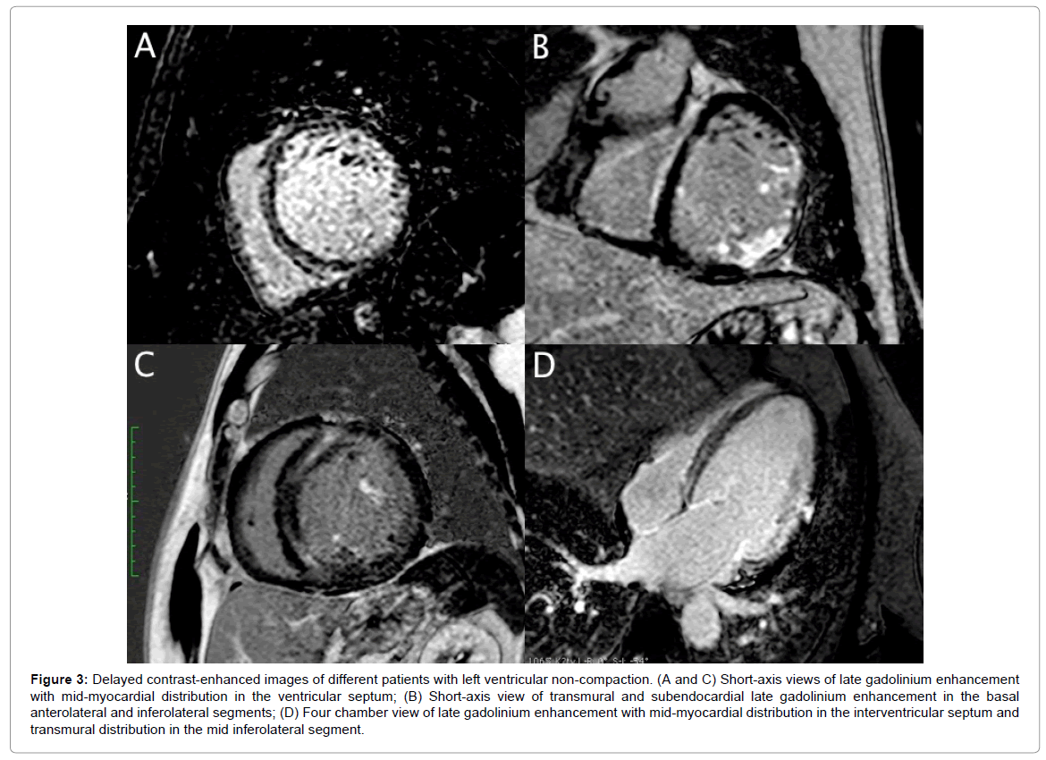 radiology-inferolateral-segment