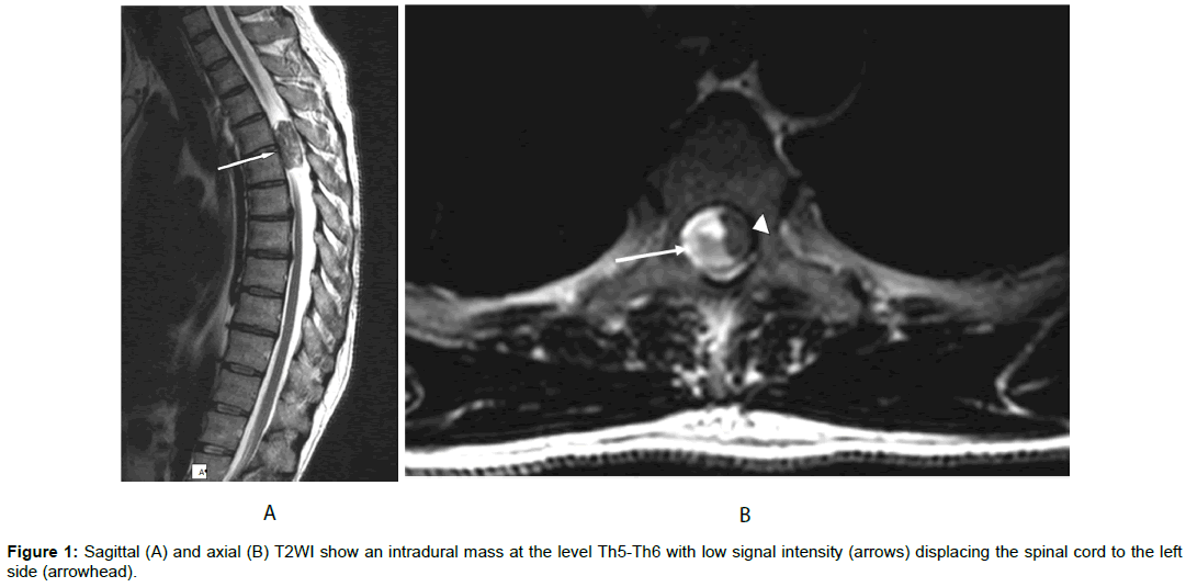 radiology-intradural-mass-level