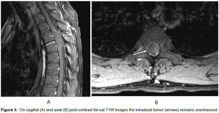 radiology-intradural-tumor