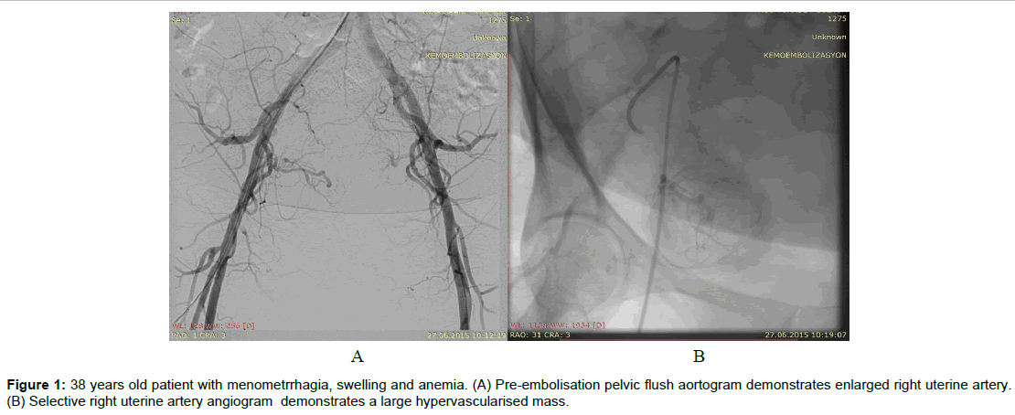 radiology-large-hypervascularised-mass