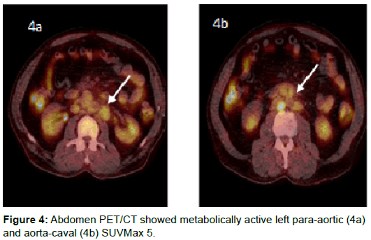 radiology-left-para-aortic