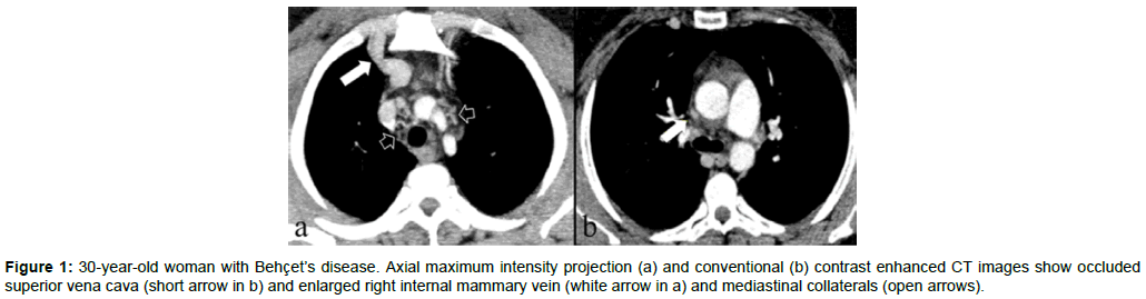 radiology-mediastinal-collaterals