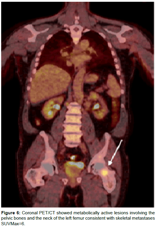 radiology-metabolically-active-lesions