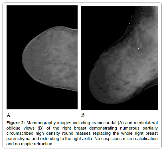 radiology-nipple-retraction