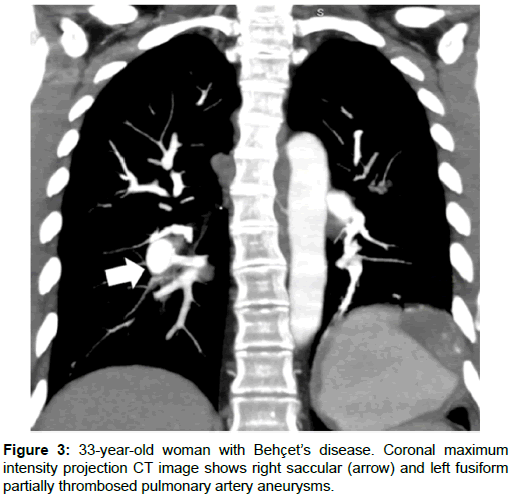 radiology-pulmonary-artery-aneurysms