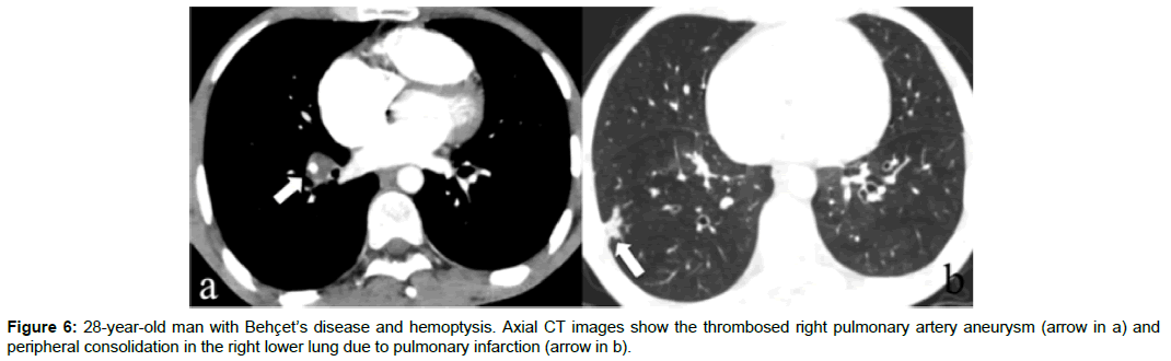 radiology-pulmonary-infarction