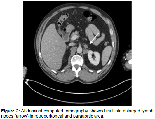 radiology-retroperitoneal-paraaortic