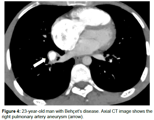 radiology-right-pulmonary-artery