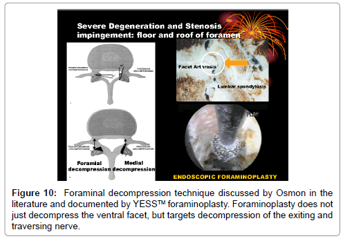 spine-foraminal-decompression-technique