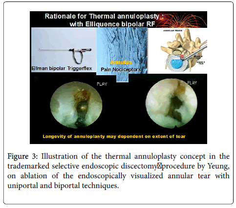 spine-thermal-annuloplasty