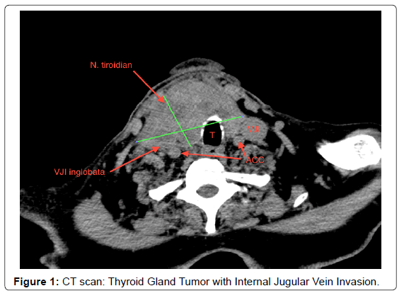 Normal Thyroid Ct Scan