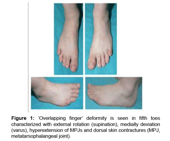 Correction Of Overlapping Fifth Toe Deformity With Combination Of Z Plasty And Transposition 