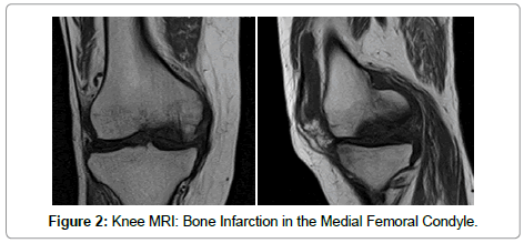 surgery-medial-femoral-condyle