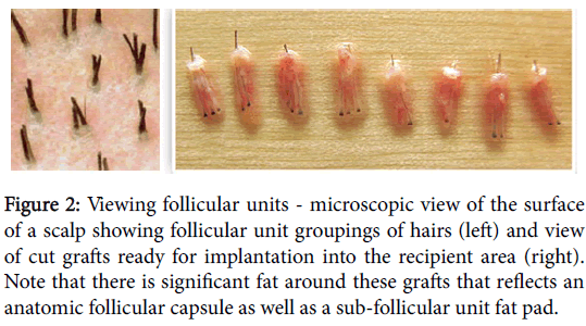 transplantation-technologies-research-follicular-microscopic-hairs