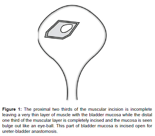 Kidney Transplant Incision