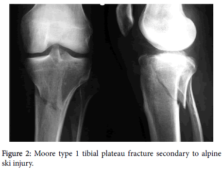 occult tibial plateau fracture