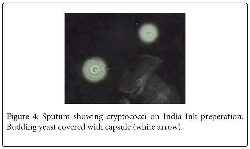 india ink staining crytpococcois