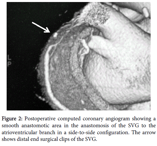 Download vascular-medicine-surgery-computed-coronary-angiogram