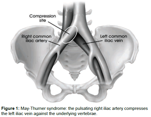 Anatomy Of May Thurner Syndrome