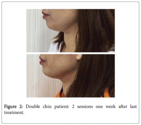 weight-loss-therapy-Double-chin-patient