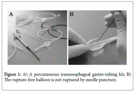 weight-loss-therapy-percutaneous-transesophageal