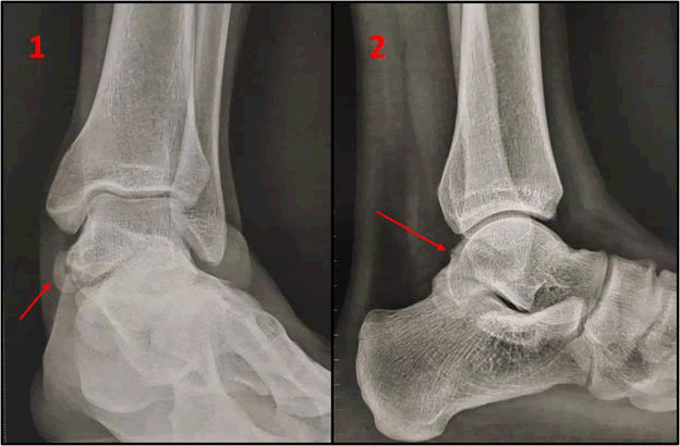 Clinical Research Foot Ankle Preoperative