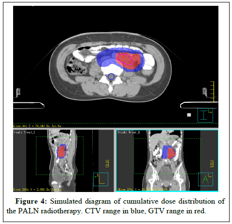 radiotherapy