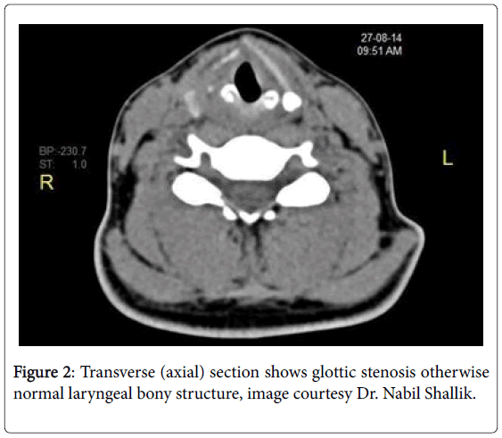 Clinical-Anesthesiology-glottic-stenosis