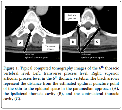 anesthesia-clinical-epidural-space