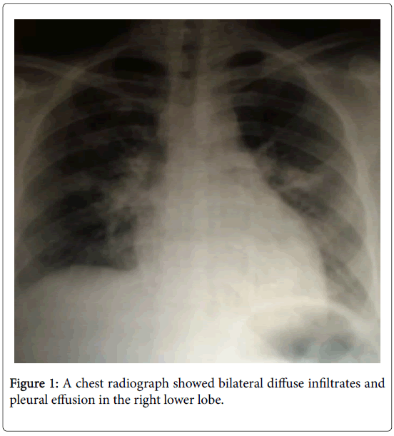 antimicrobial-chest-radiograph