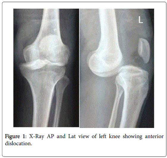 Traumatic Anterior Dislocation of the Knee Without Any Neurovascular