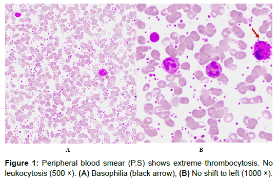 Lymphoma Peripheral Blood Smear