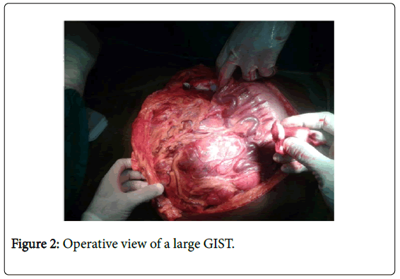 Voluminous Gastric Stromal Tumors Place of Surgery about