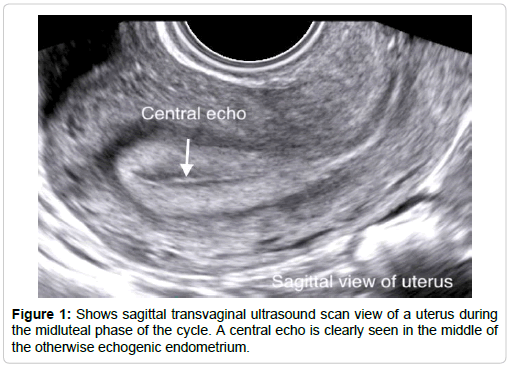 Endometrial Echo 中文 Malua