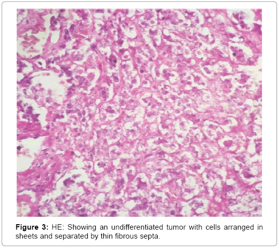 clinical-case-reports-undifferentiated-tumor