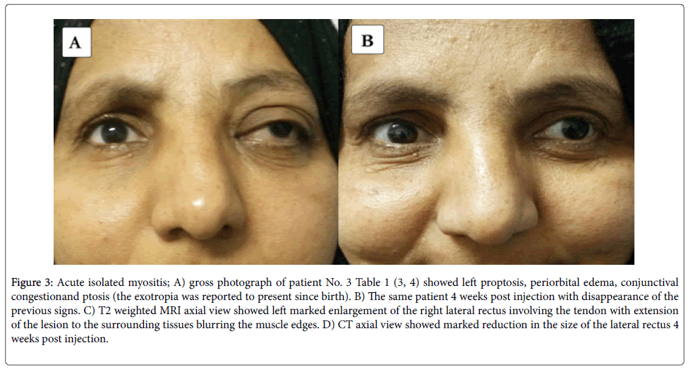 Periorbital Edema Causes Symptoms And Treatment