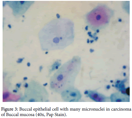 Sugainya Sex Pottos - Journal of Clinical & Experimental Pathology - The Role of Micronuclei as a  Screening Tool in Oral Cancers