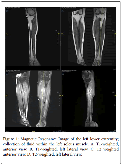 An Unusual Case Of Pyomyositis In A Neutropenic Patient With - 