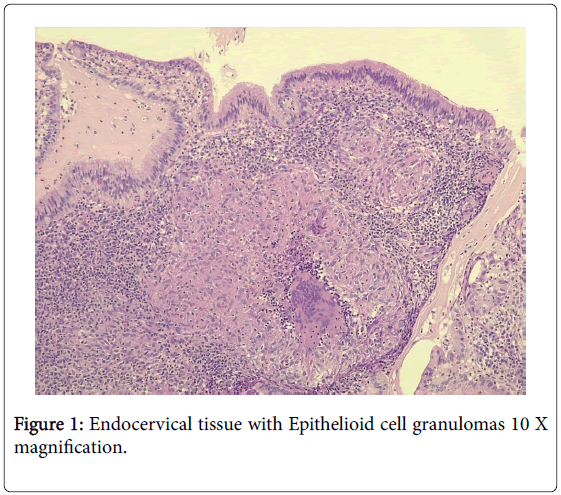 clinical-medical-case-reports-endocervical-tissue-granulomas