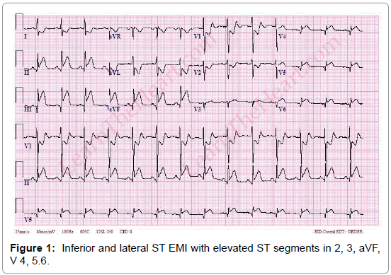 coronary-heart-diseases-elevated-ST-segments